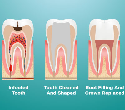 root canal