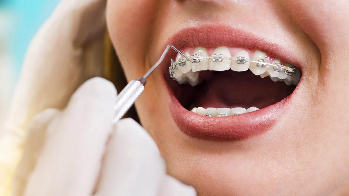 adult getting teeth braces