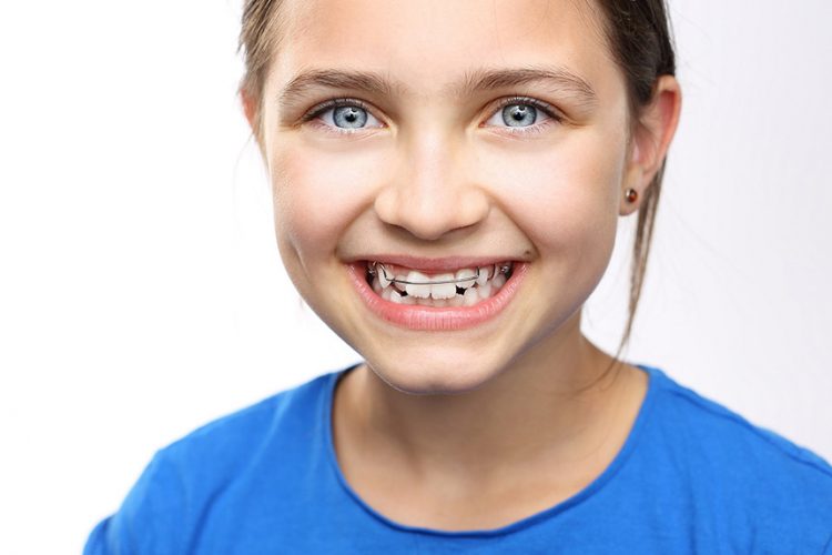 kid with a teeth retainer braces