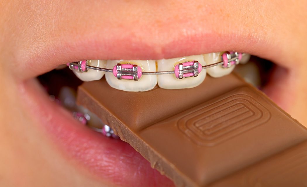eating with braces