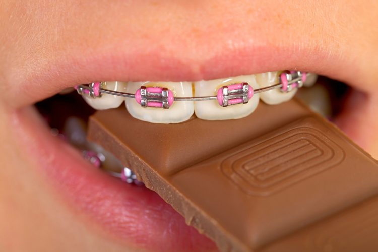 eating with braces