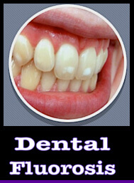 dental fluorosis