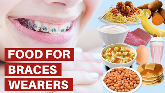 5 Foods To Avoid When You Are Wearing Braces 