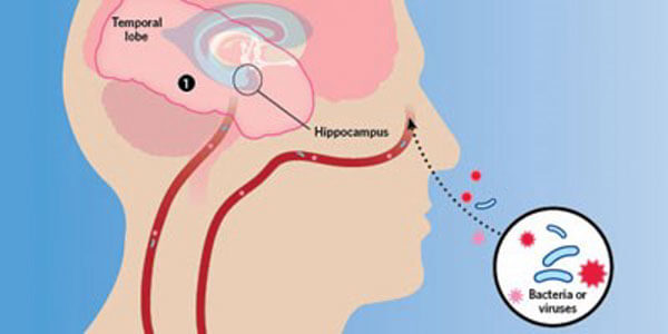 brain-infection-and-alzheimer-s-disease-pathology-l