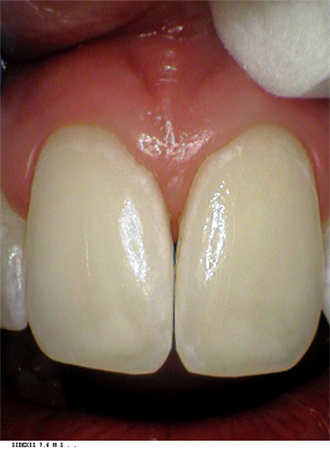 white spots on teeth using non invasive ICON system after