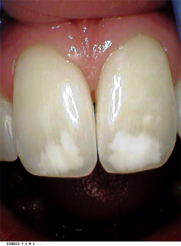white spots on teeth using non invasive ICON system before