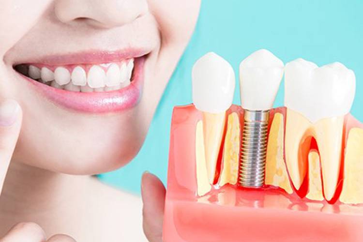 dental implant