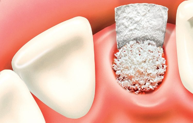 dental bone grafting