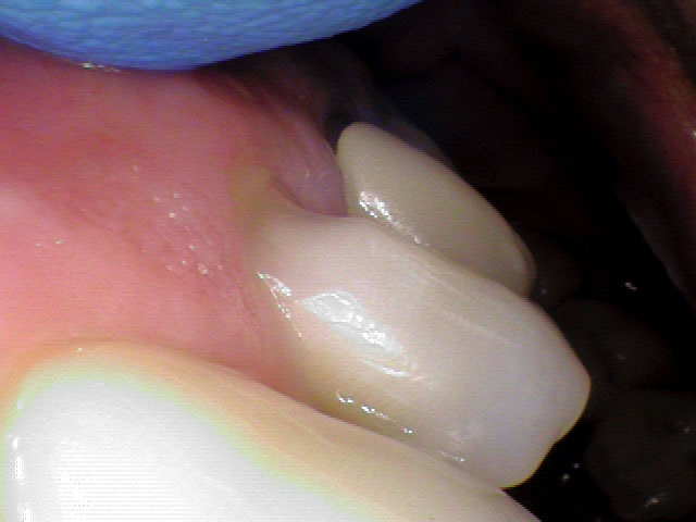 abfraction case before