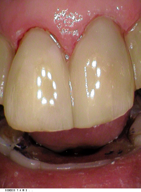 teeth after the bonding procedure