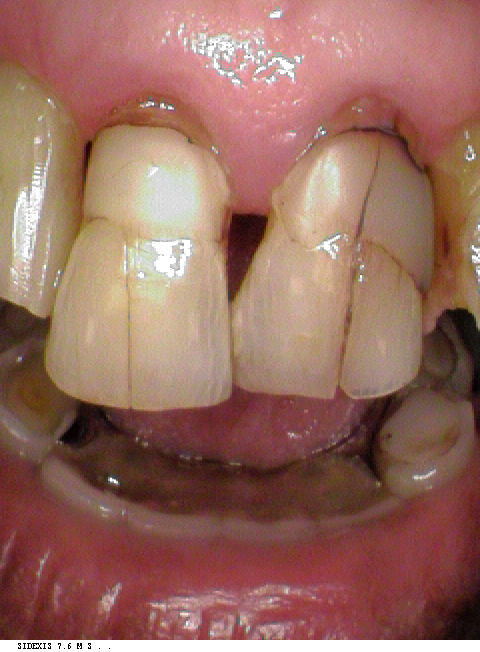 teeth before the bonding procedure