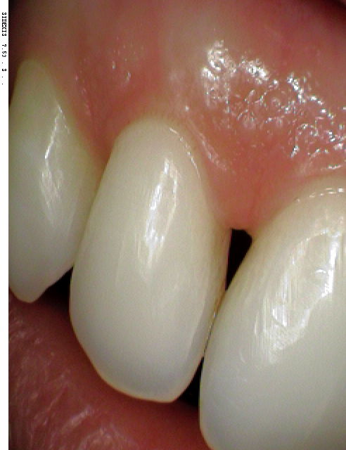 teeth before being treated