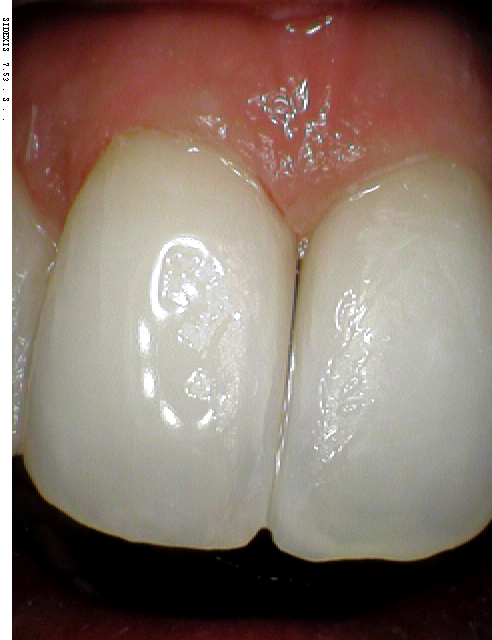 teeth after being treated