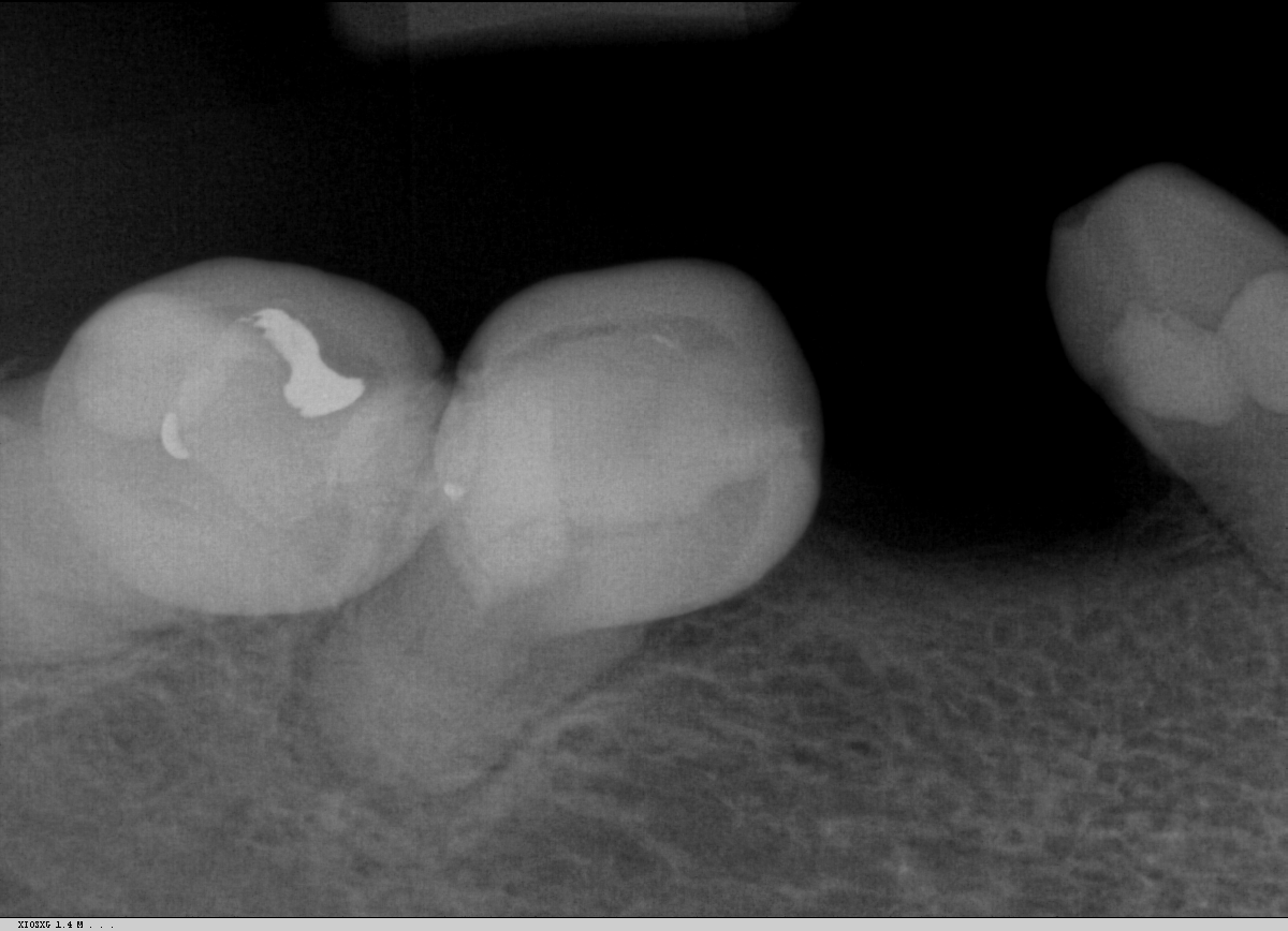 teeth x-ray