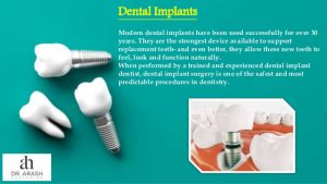 dental implants