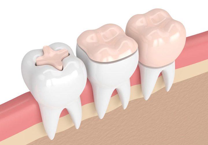 dental inlays and onlays