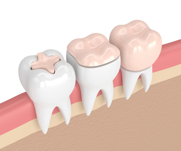 dental inlays and onlays