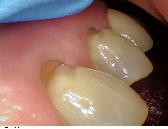 dental erosion case before