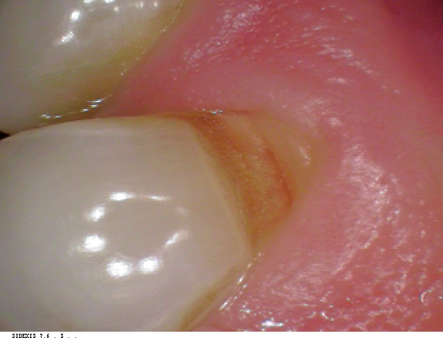 dentalerosion casebefore