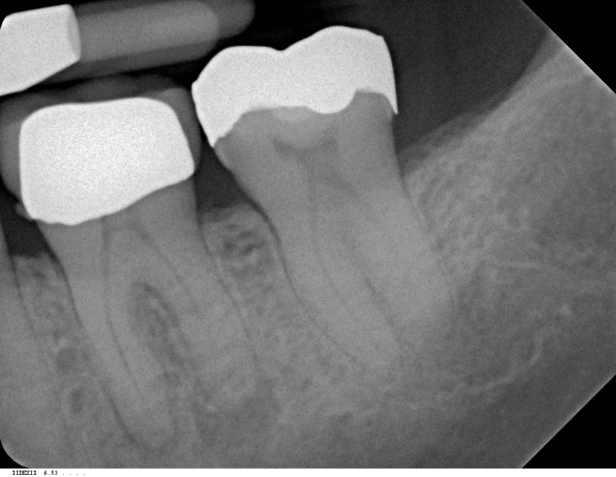 Root Canal Treatment Thru Dental Crowns St Lawrence Dentistry