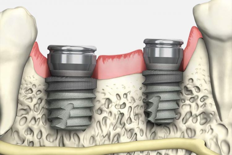 a dental implant in the bone