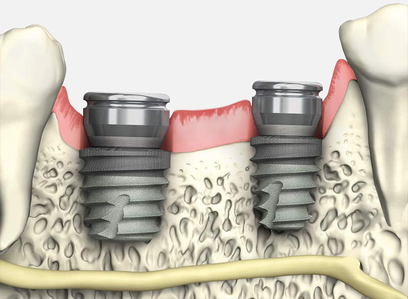 a dental implant in the bone