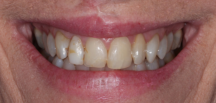 before the teeth treatment procedure