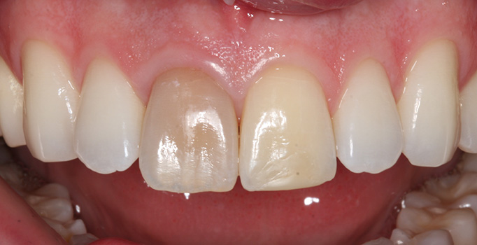 before the teeth treatment procedure