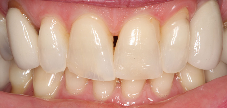 before teeth procedure
