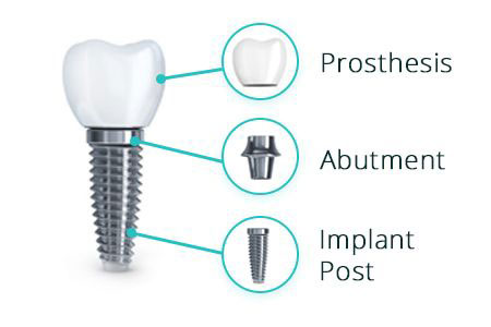 dental-implant-abutment-prosthesis