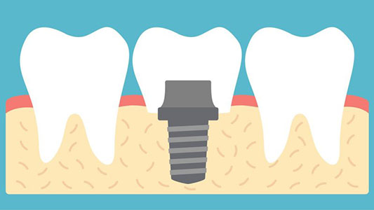 dental-implant-new-hero-img-blue-800x450