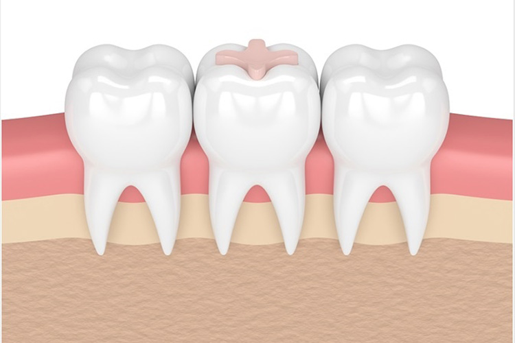 glass ionomer on a teeth