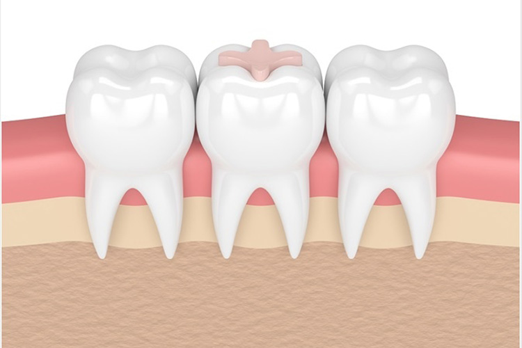 glass ionomer on a teeth