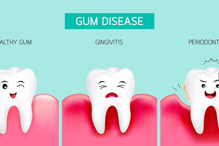 gum diseases