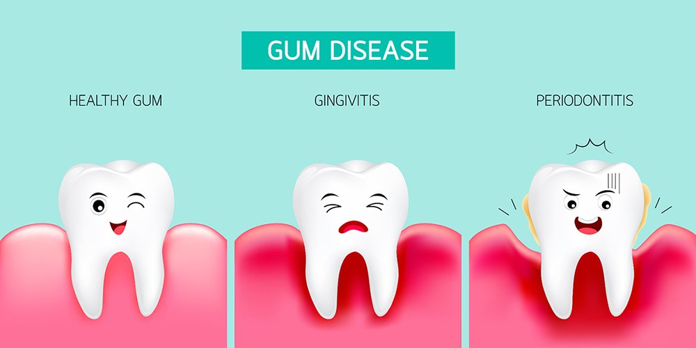 gum diseases