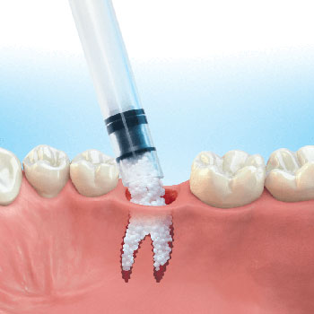 bone grafting procedure