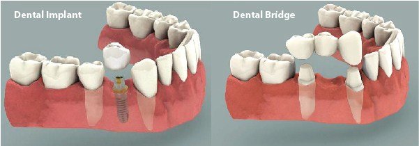 dental_implants_vs_bridge