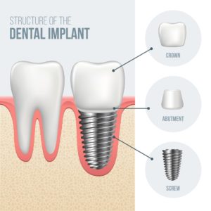 dental crown implant