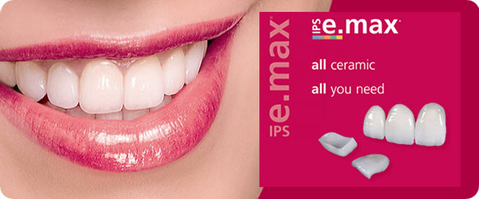 emax veneers