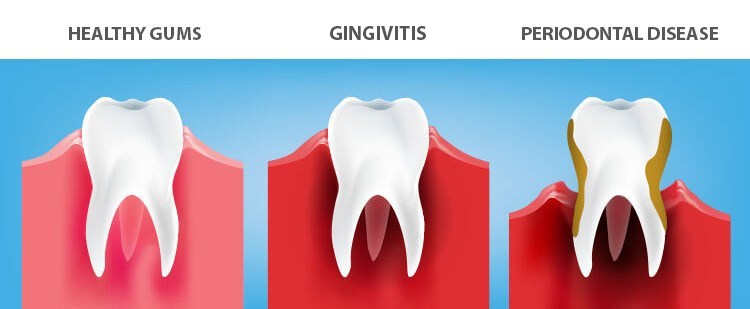 gingivitis periodontal disease