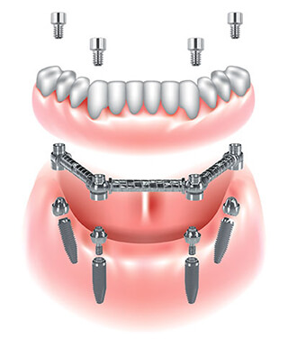 Clip Abutment Bar