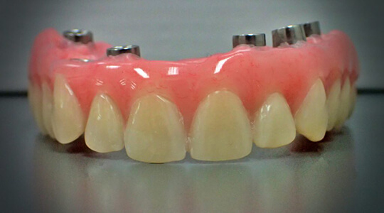 Fixed Implant Retained Hybrid Dentures