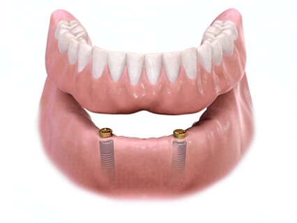 Removable Implant-Supported Overdenture