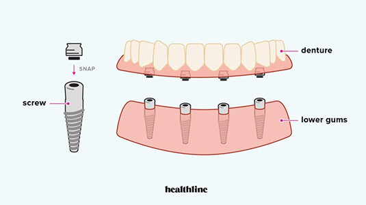 Snap-In Dentures