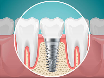 space needed for dental implant