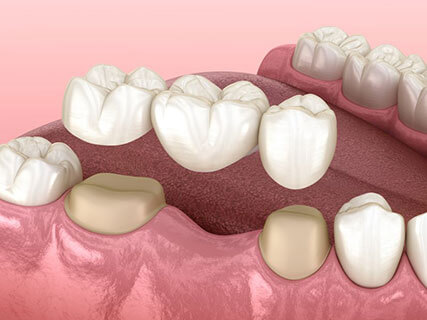 dental crown vs bridge