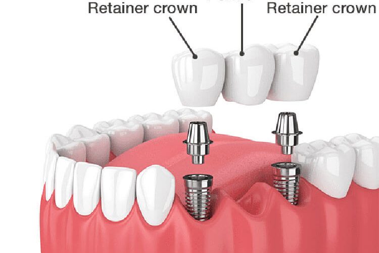 Dental Bridge Implants