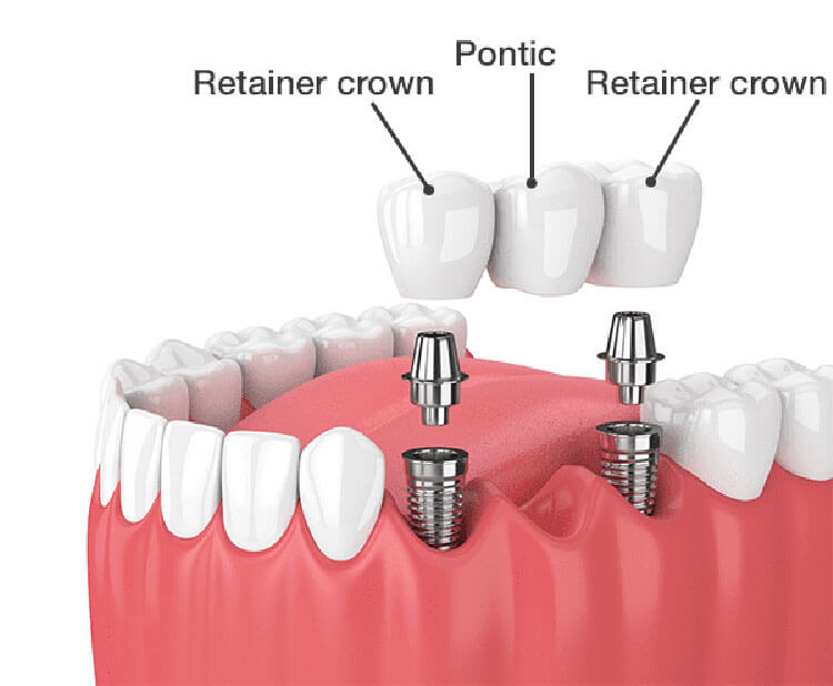 Dental Bridge Implants
