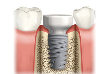 healing abutment