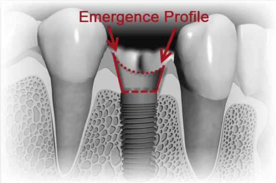 implant scanned